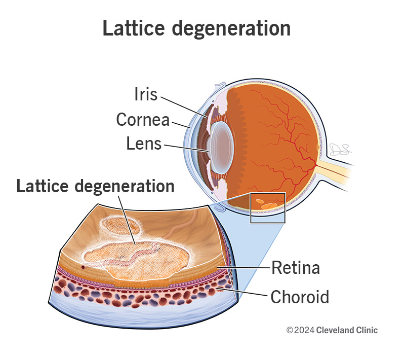 Lattice degeneration causes tissue thinning and weakening on the surface of your retina that looks like lattice framework