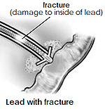 Lead with Fracture