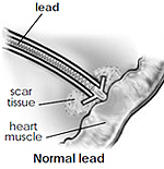 Normal Lead