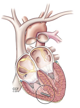 Blyfri pacemaker