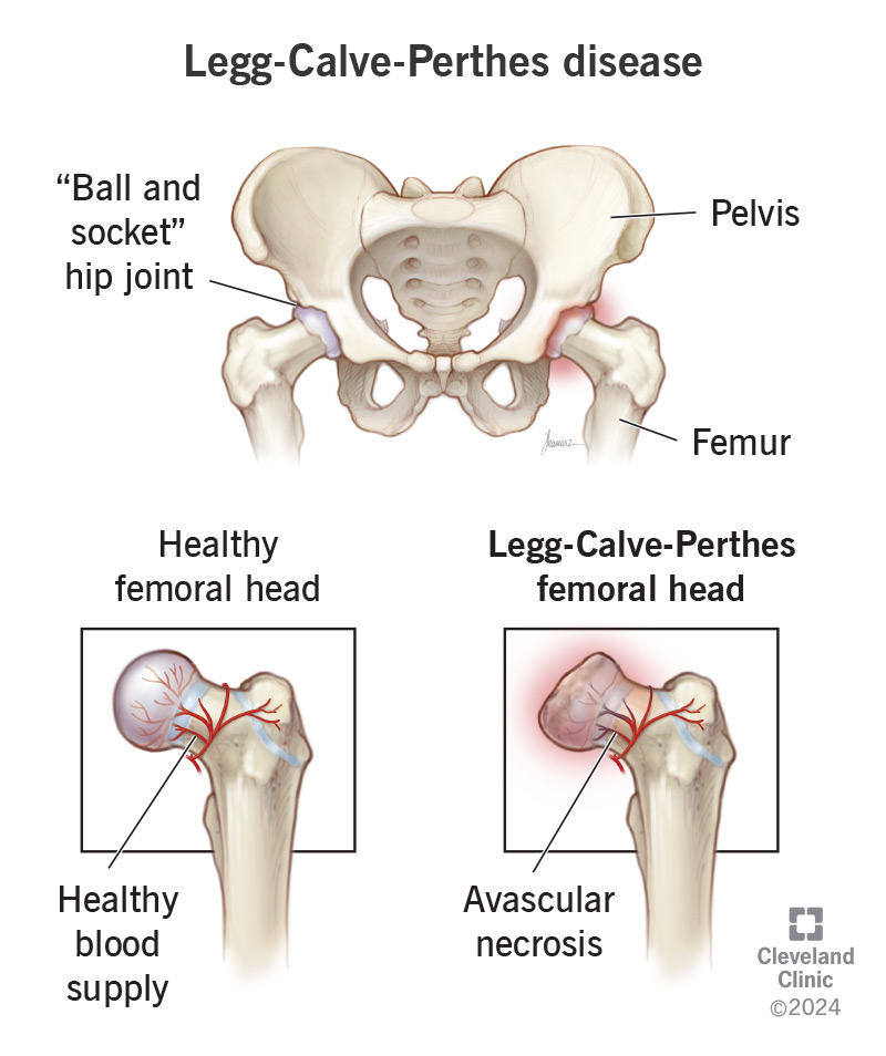 A healthy femur vs. a femur with Legg-Calve-Perthes disease. The diseased femur head has started to waste away.