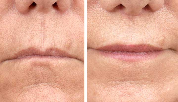 A person’s lips before and after a lip lift procedure.