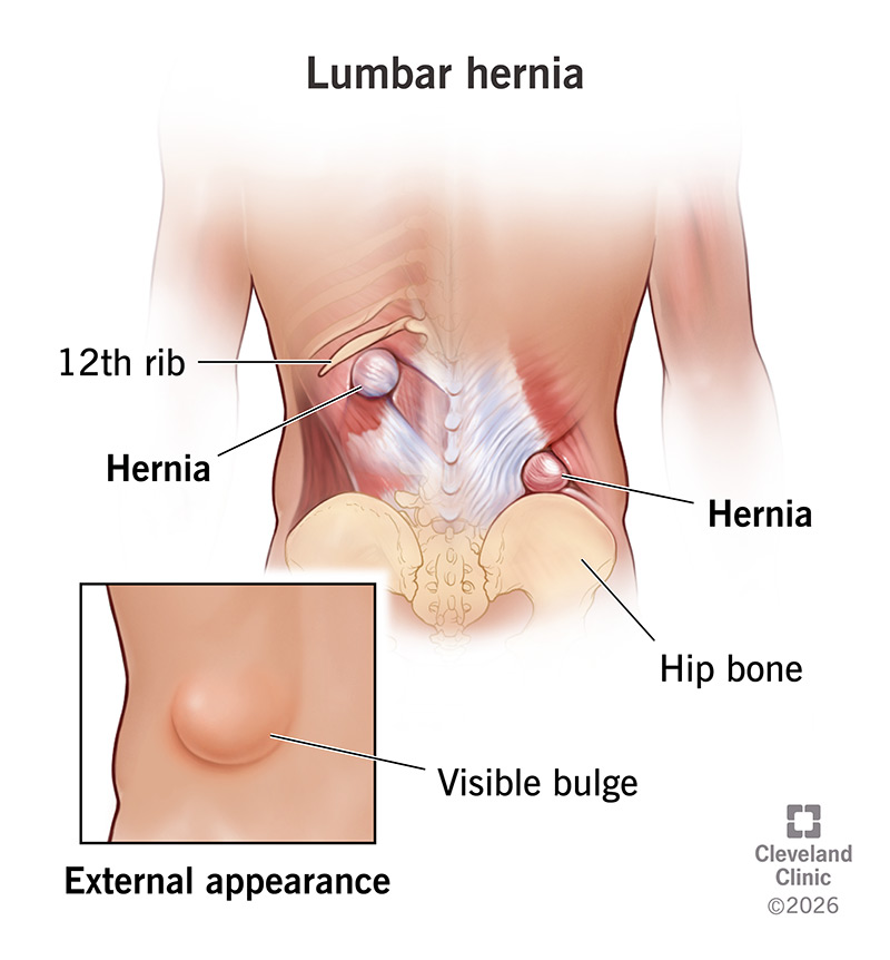 A lumbar hernia produces a bulge beneath the 12th rib and above the hip bone