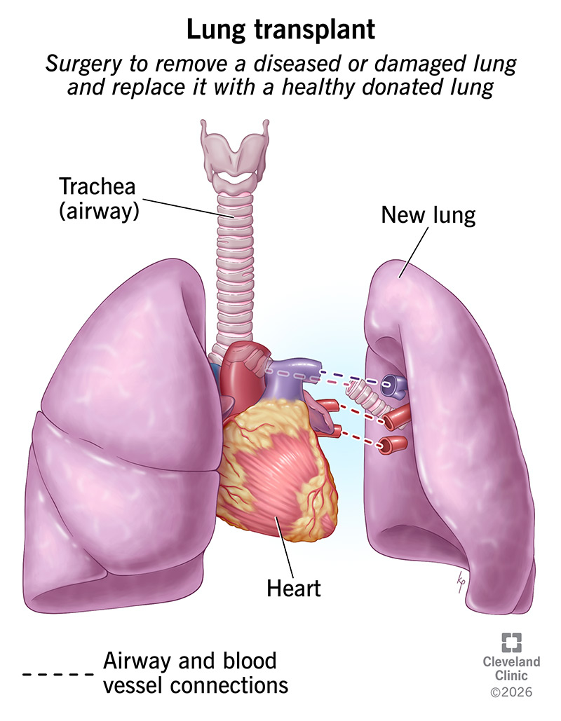 Anatomy of lung transplant, removing diseased or damaged lung, connecting donor lung to blood vessels and airways