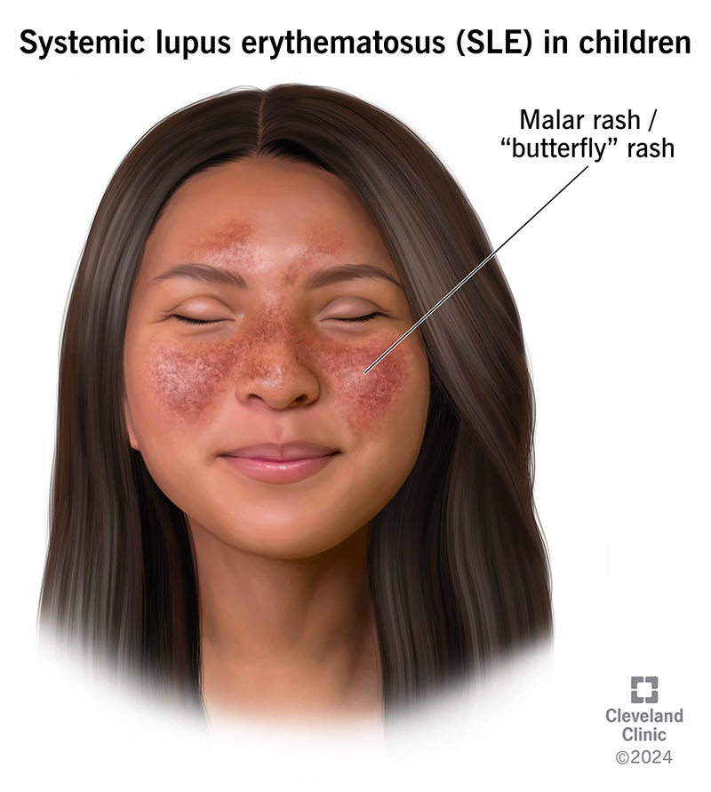 Children with lupus may develop a rash on their cheeks and the bridge of their nose that resembles a butterfly's shape.