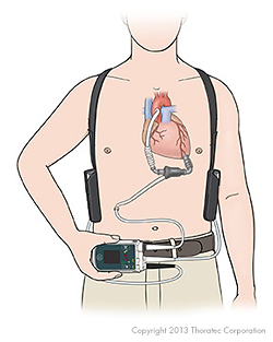 Left Ventricular Assist Devices (Mechanical Circulatory Support MCS ...