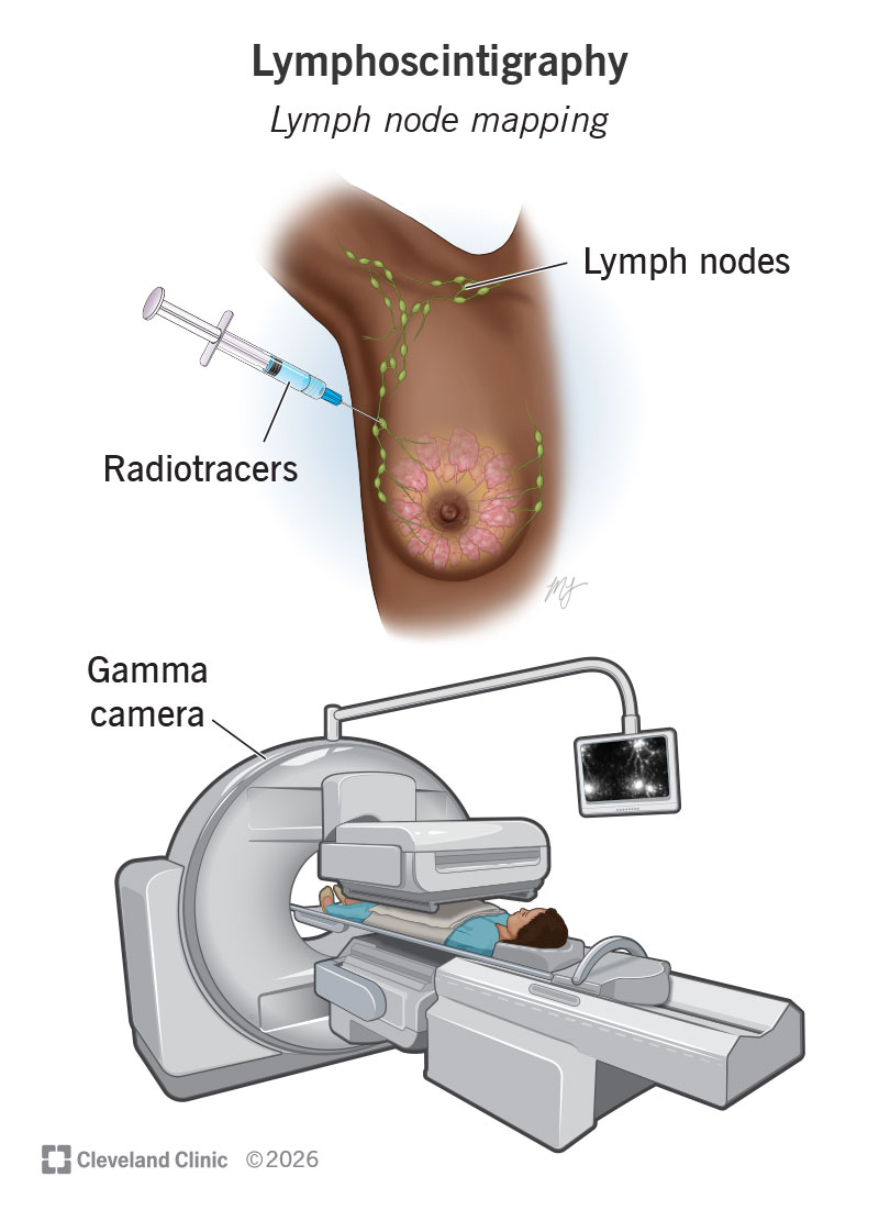 A lymphoscintigraphy uses radiotracers and a gamma camera to look for cancer cells