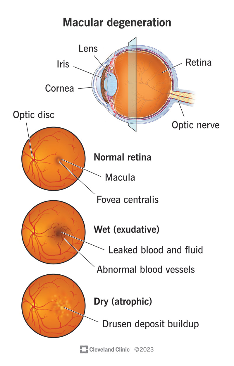 Both the wet and dry forms of macular degeneration affect the macula, which is part of the retina of your eye.