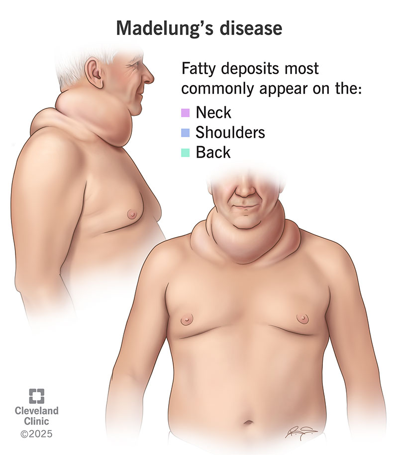 Person with fatty deposits around their neck, shoulders and upper back