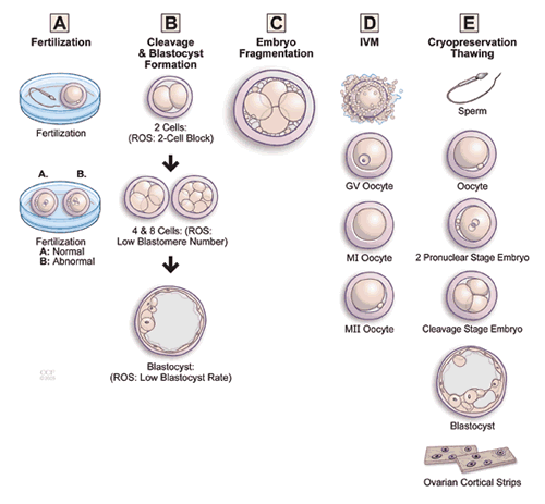 Male Infertility | Cleveland Clinic