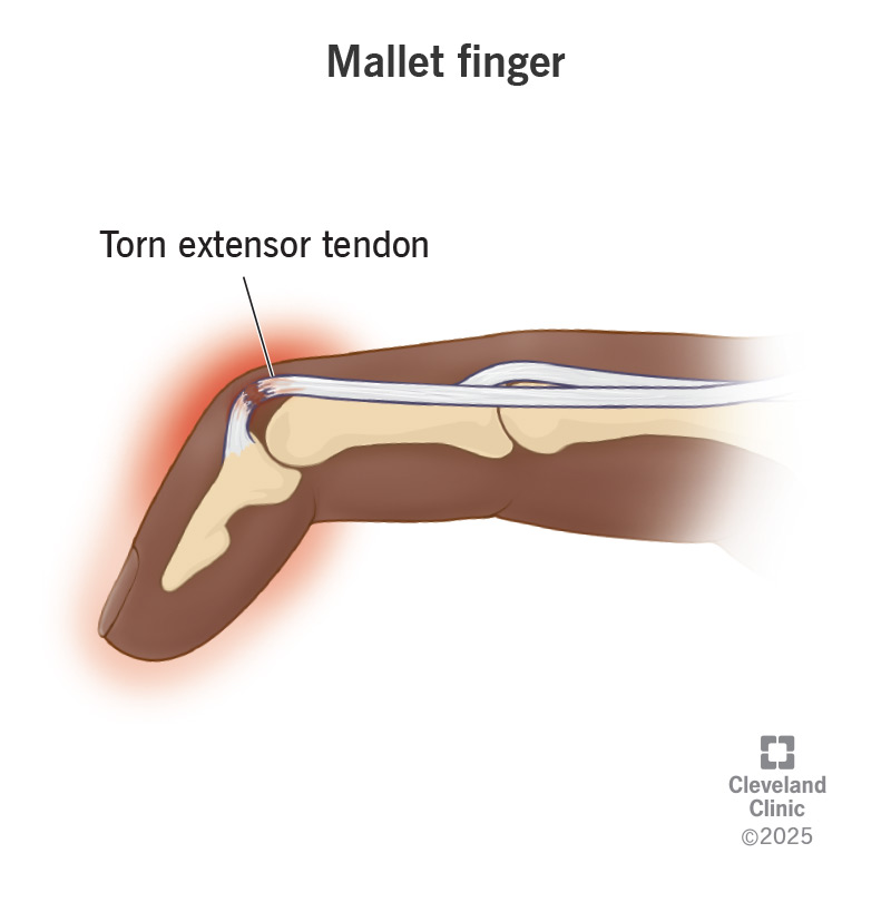 Mallet finger occurs when the tip of your finger droops downward. An injury to your extensor tendon causes it.