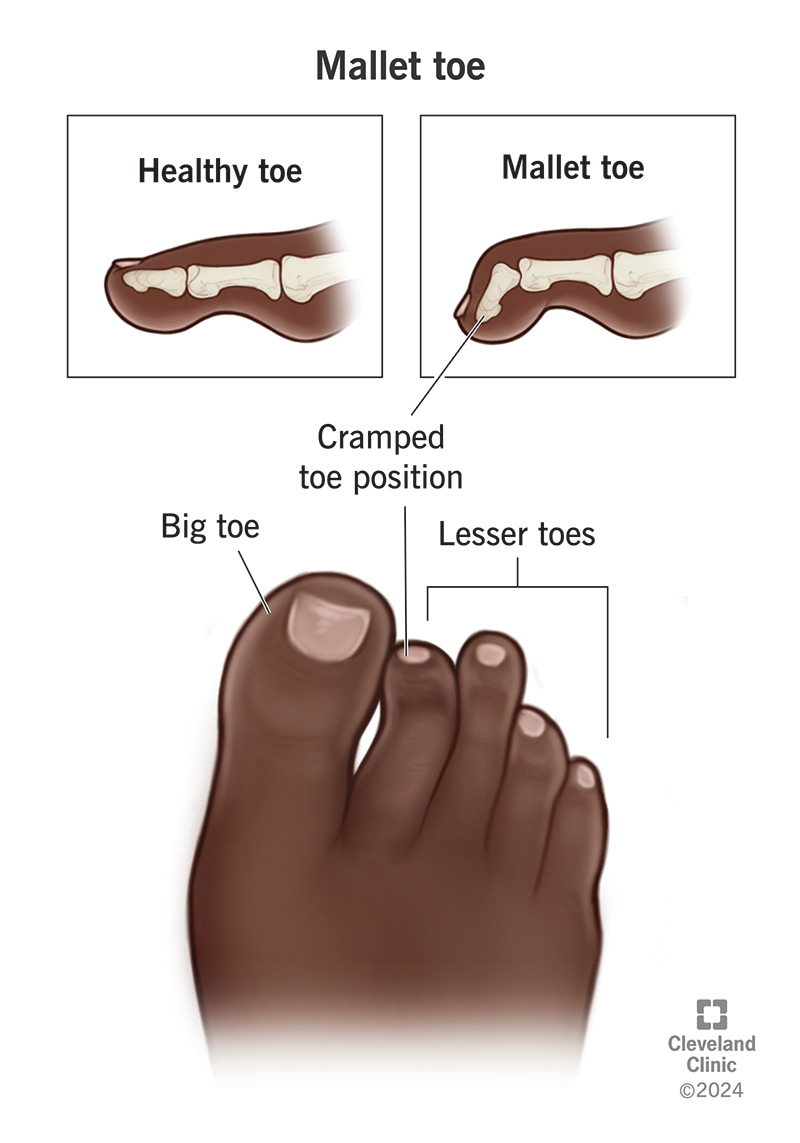 Illustration showing mallet toe from the outside and inside.