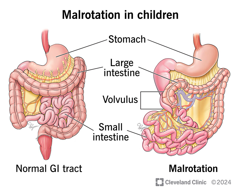 When your child has malrotation, their intestines don’t coil and rotate as far as they should