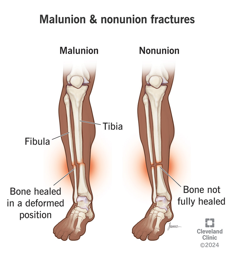 A malunion fracture has healed in the wrong position. A nonunion fracture has failed to heal over time.