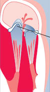 Mitral Valve Prolapse | Cleveland Clinic