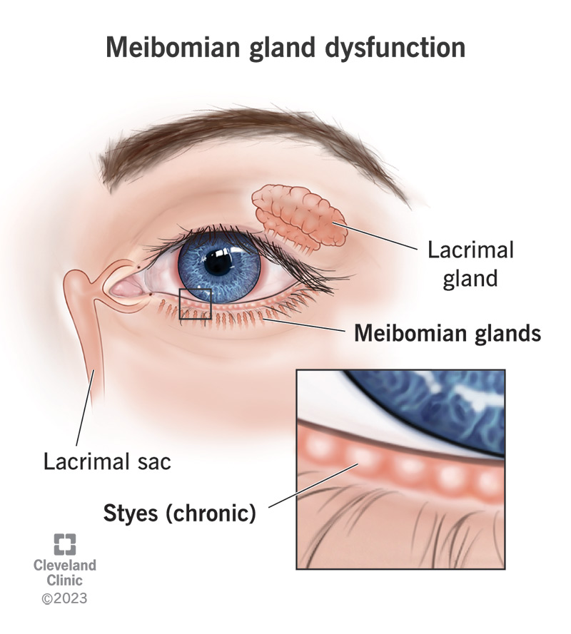 Meibomian gland dysfunction may cause chronic styes.