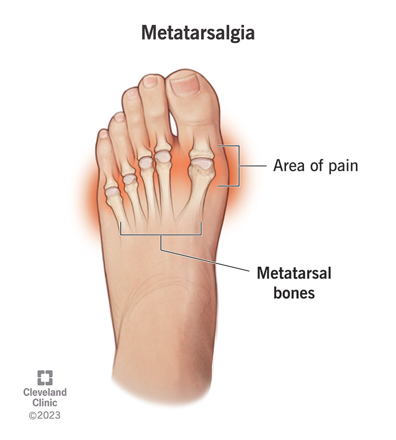 Metatarsalgia refers to pain and inflammation in the ball of your foot, or forefoot.