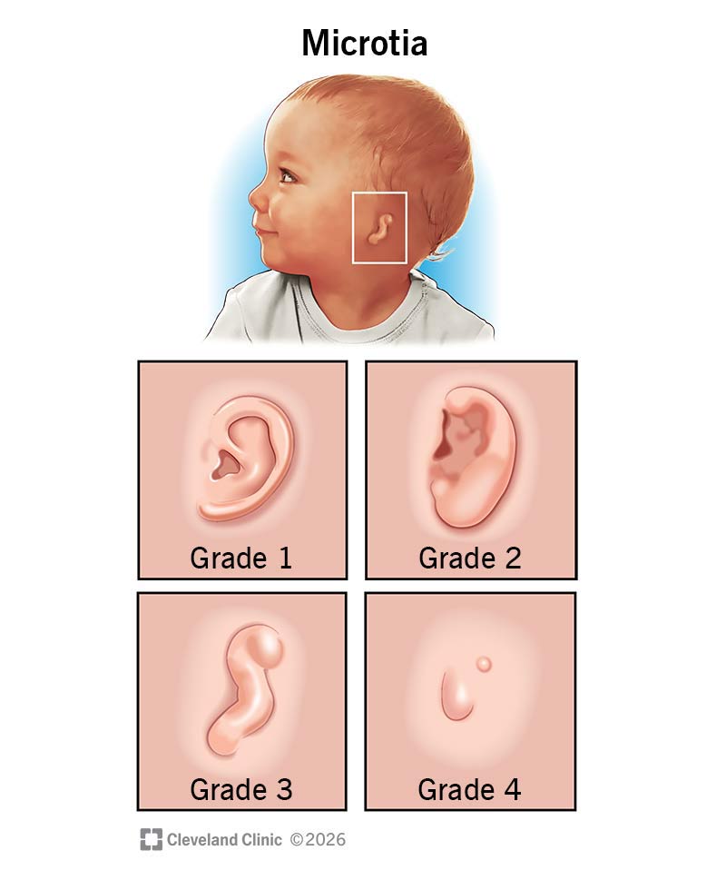 Microtia affects the shape and size of babies’ outer ears and can cause hearing loss