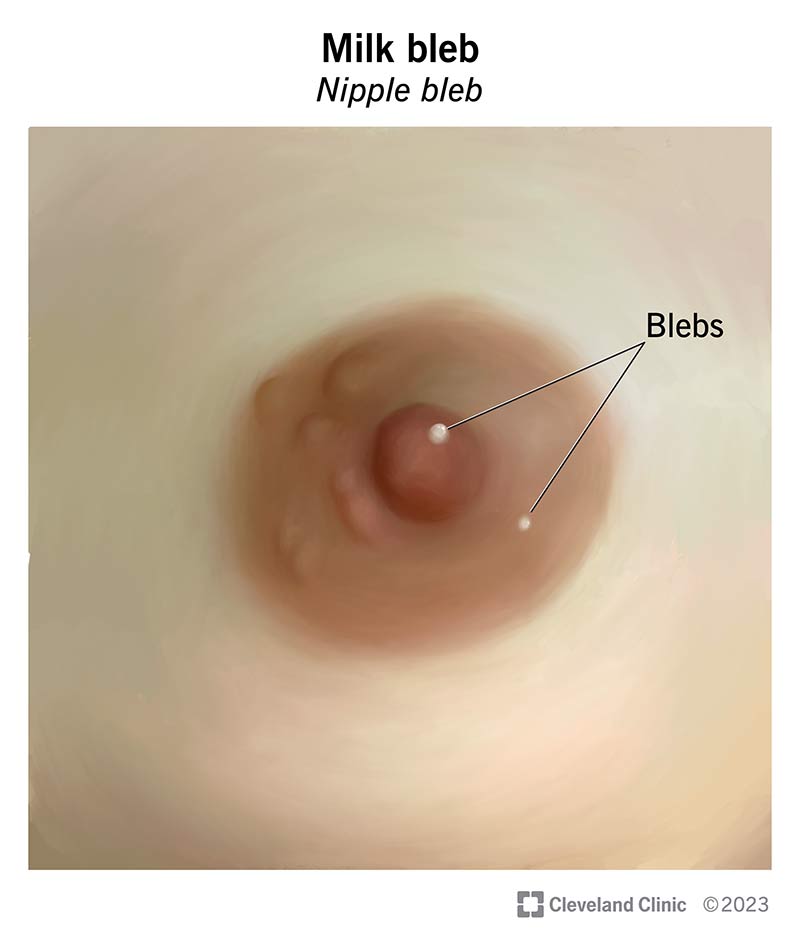 Small white and yellow milk bleb dots on a nipple