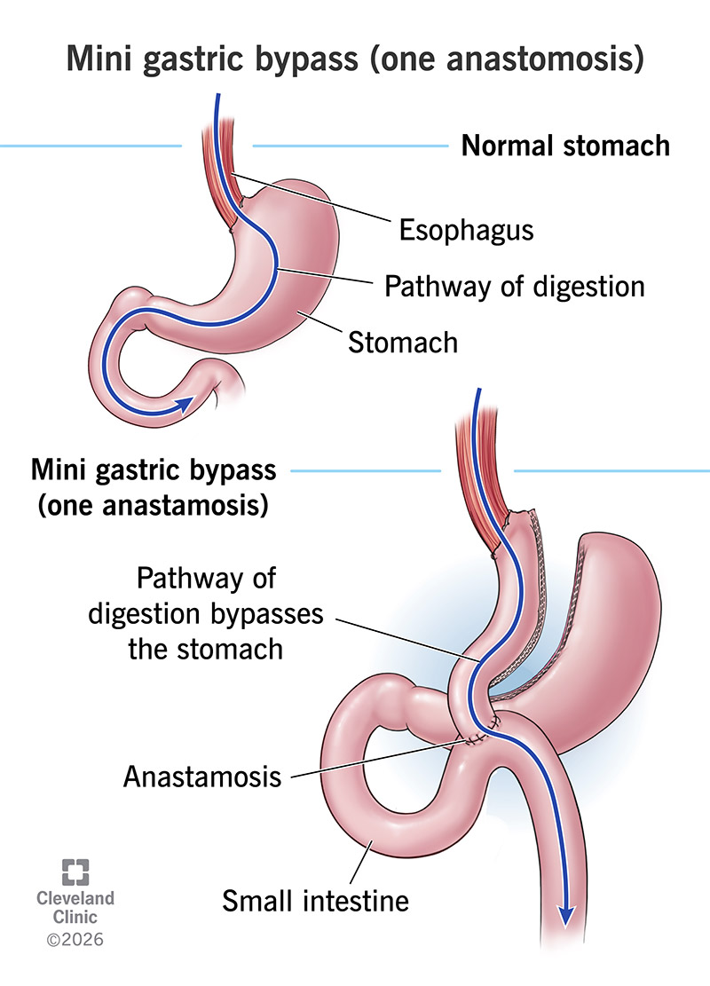 Normal stomach compared to a stomach after mini gastric bypass with a smaller stomach and shorter path for digestion