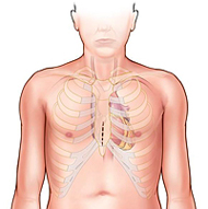 sternotomie partielle