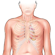 Мини-торакотомия