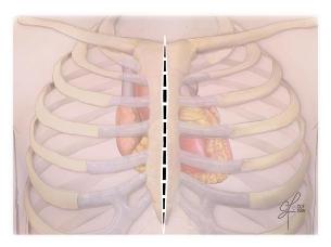 Prolapsus valvulaire mitral mini-invasif