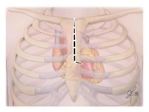 Teilweise obere Sternotomie