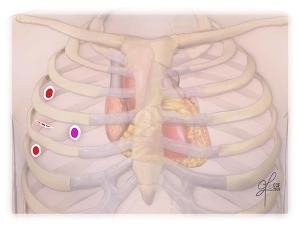 Mitral Kapak Tamiri