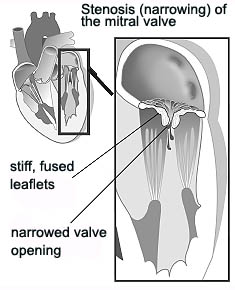 Mitralklappenstenose (verengte Öffnung)