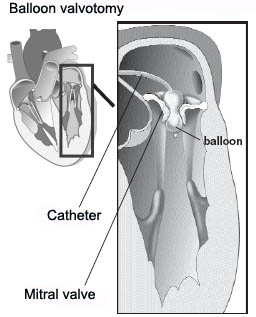 Walwotomia mitralna balonowa