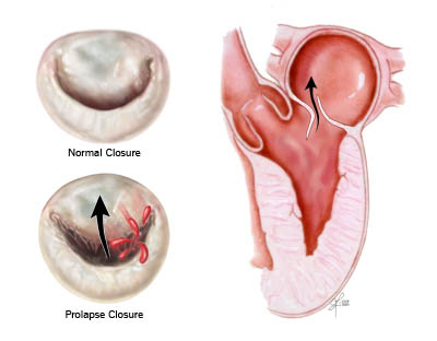 Mitral kapak prolapsusu