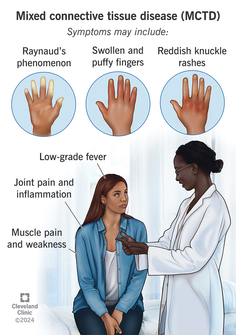 MCTD symptoms may range from Raynaud’s phenomenon to muscle pain and weakness