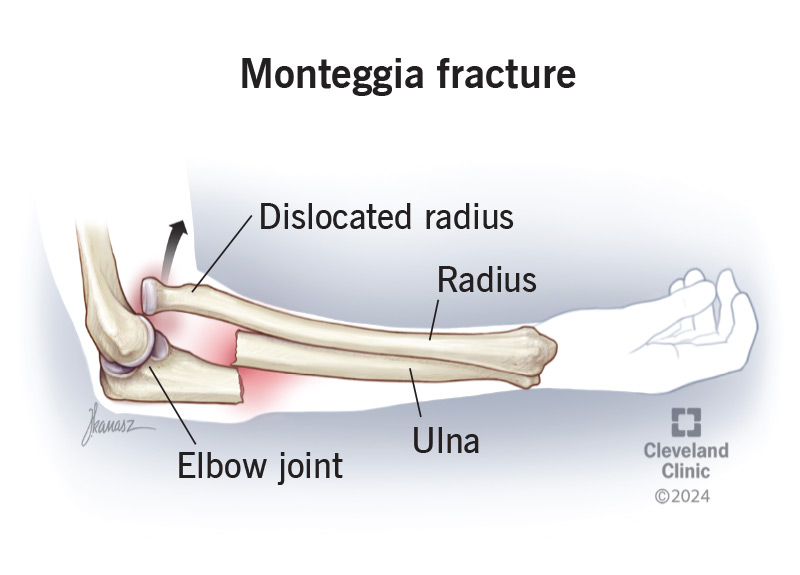 Illustration of the dislocated radius bone and fractured ulna bone at the elbow joint (Monteggia fracture).