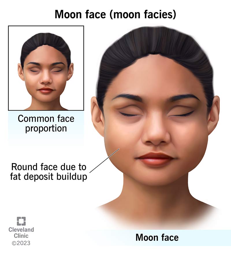 Comparing a common face proportion with moon face (moon facies).