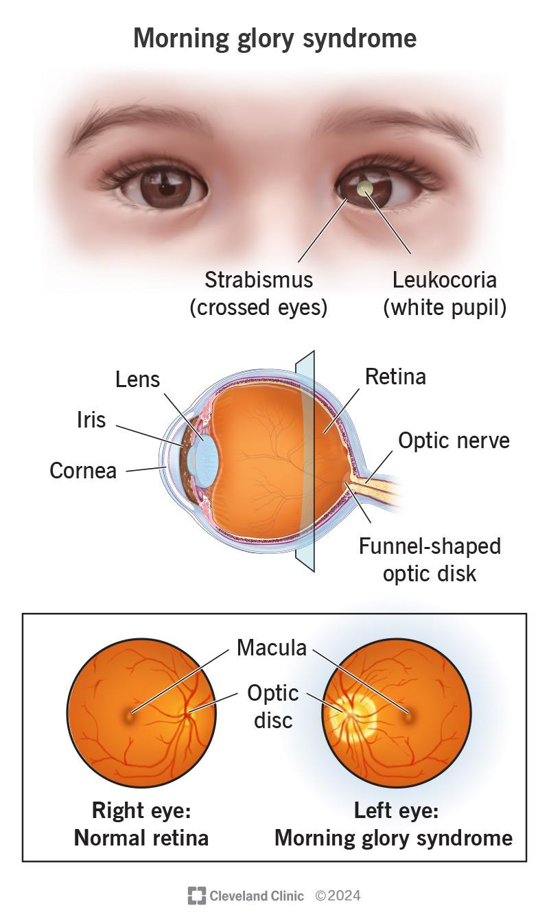 Morning glory syndrome causes your optic disk and cup to be too wide and too deep, which can lead to later eye problems.