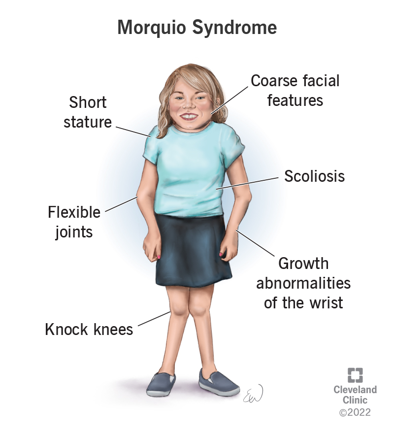 Nursing Paper Example on Morquio Syndrome [SOLVED]