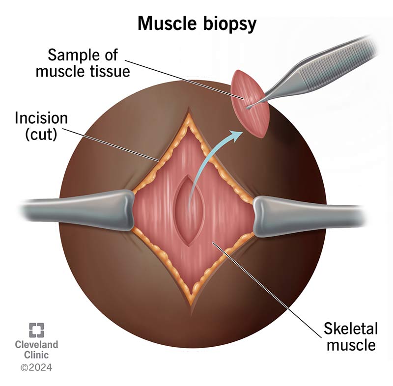 Muscle biopsy, witha cut (incision) on the skin, revealing muscle underneath