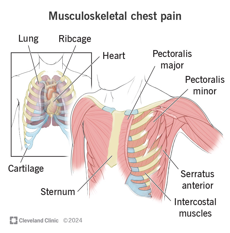 Musculoskeletal chest pain involves the muscles, bones or connective tissues in your chest.