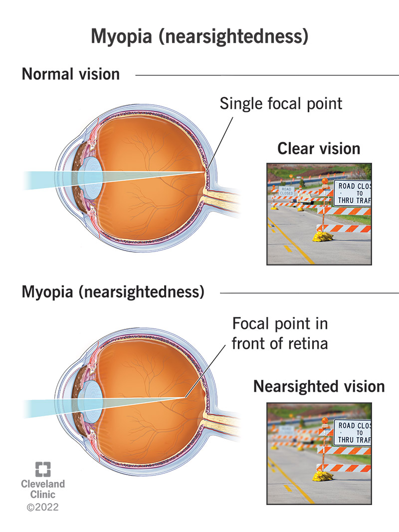 A blurry street sign with myopia (nearsighted) vs. a clear street sign with normal vision.