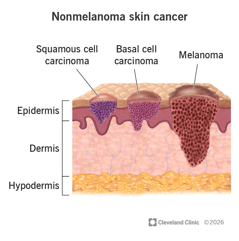 Comparison of nonmelanoma skin cancers (squamous cell carcinoma and basal cell carcinoma) to deeper-growing melanoma