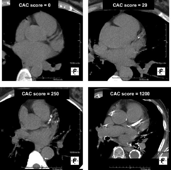 CT scan images from a calcium score test.