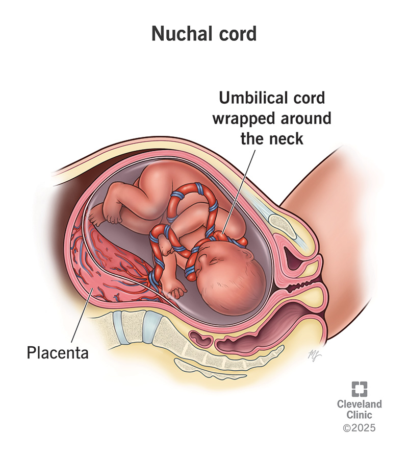 Illustration showing a fetus in the uterus with the umbilical cord around its neck. It also shows the placenta