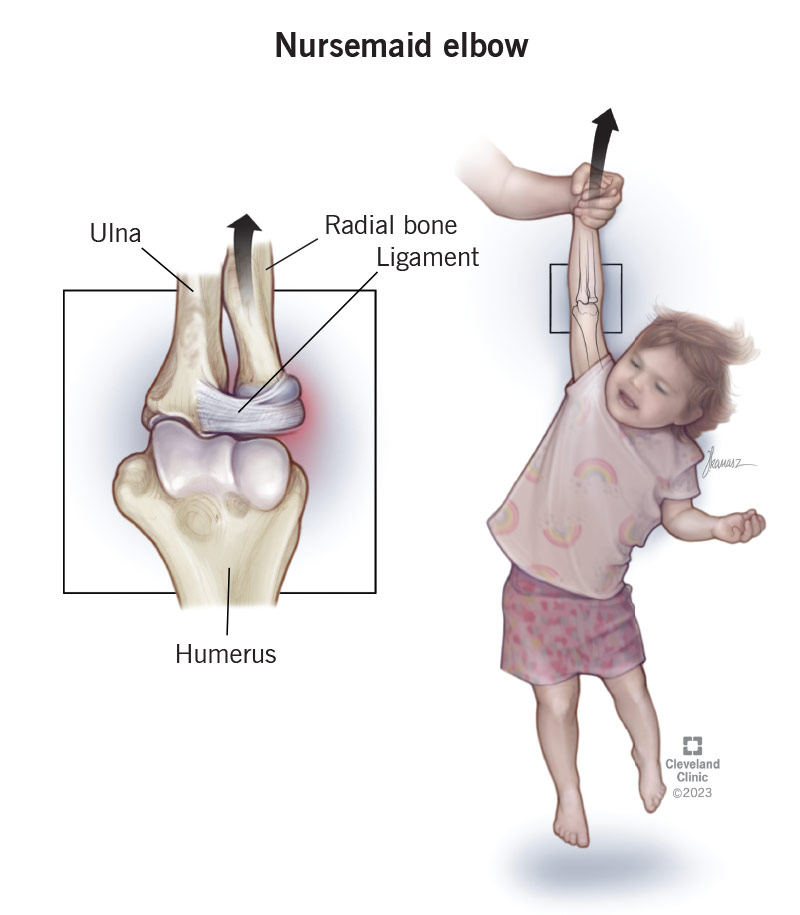 Nursemaid elbow means the tiny radial bone in your child’s elbow joint partially dislocates.