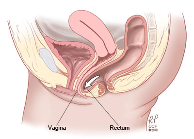 Vaginal Prolaps Rectocele