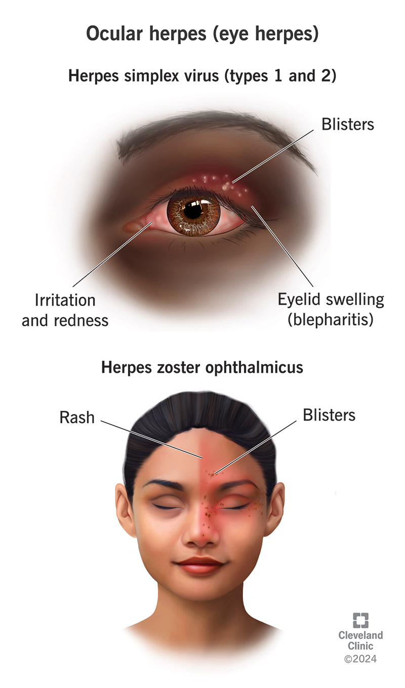 Eye herpes can cause blisters and swelling on the skin of your face around your eyes or eye irritation and redness.