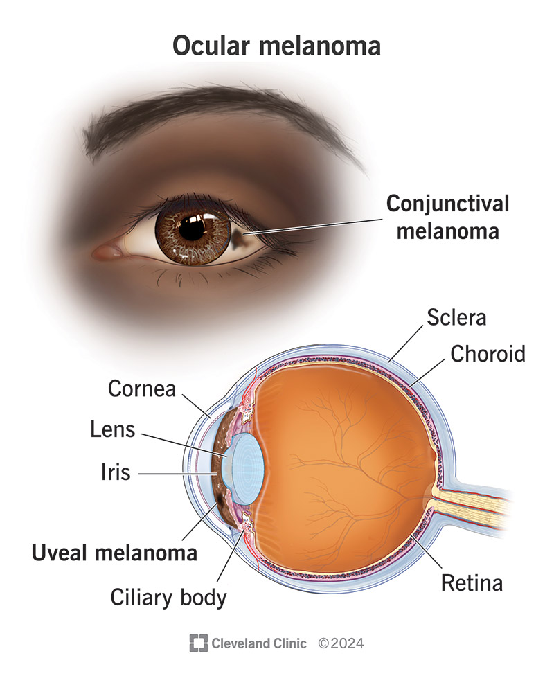 Ocular melanoma in the conjuctiva and uvea