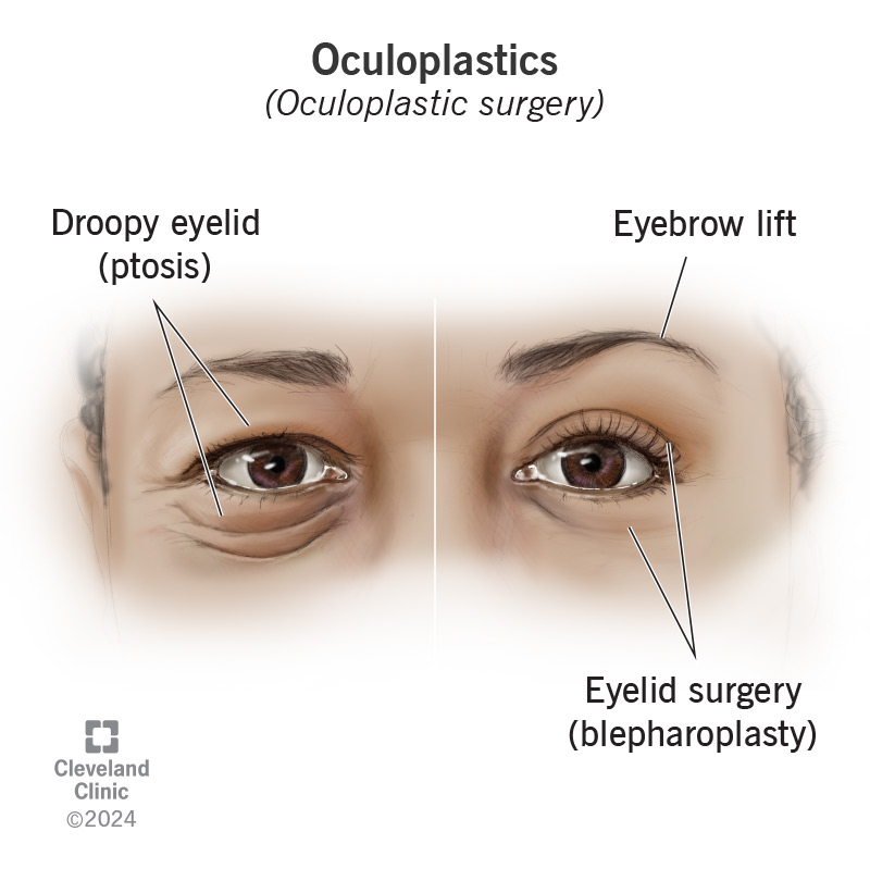 Oculoplastics involves surgeries that change the appearance of your eye or the surrounding tissue