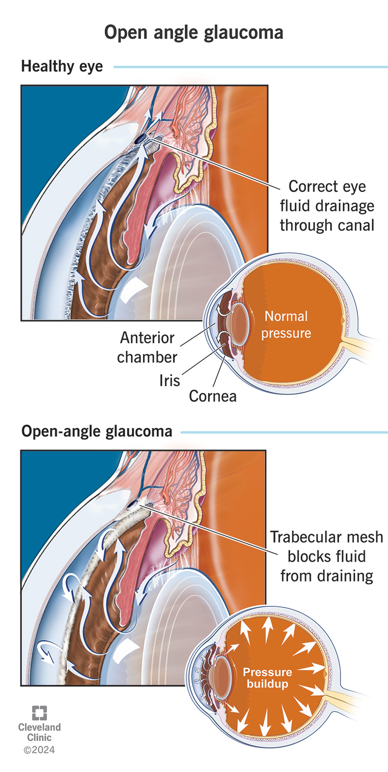 Illustration showing how eye fluids fail to drain in open-angle glaucoma.