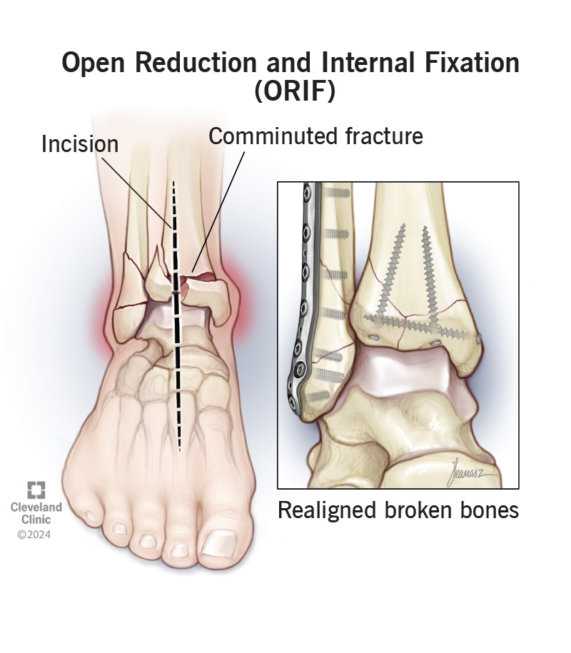 During an open reduction and internal fixation, your surgeon will realign your bones and secure them in place